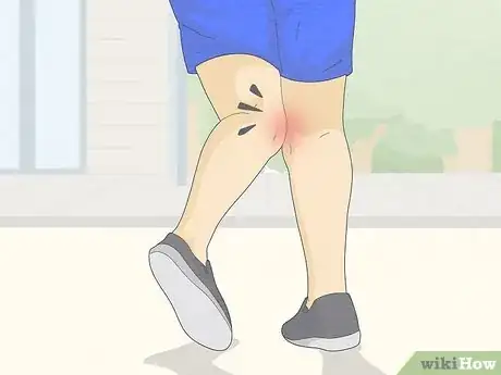 Image titled Fix Knock Knees Step 18