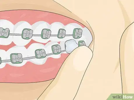 Image titled Temporarily Fix a Loose Wire on Your Braces Step 7