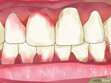 Image titled Reverse Dental Bone Loss Step 14