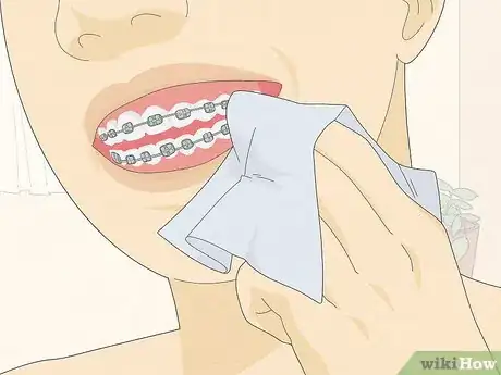 Image titled Temporarily Fix a Loose Wire on Your Braces Step 6