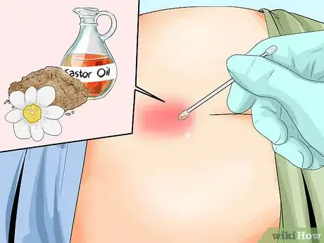 Image titled Treat a Pilonidal Cyst Step 9