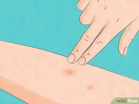 Image titled Stop Bed Bug Bites Immediately Step 14