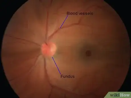 Image titled Use an Ophthalmoscope Step 14