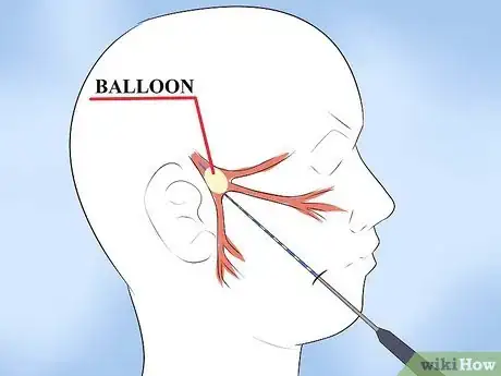 Image titled Alleviate Pain Caused by Trigeminal Neuralgia Step 8