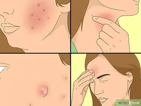 Image titled Treat Acne with Apple Cider Vinegar Step 18