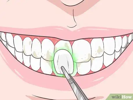 Image titled Remove Brown Stains from Teeth Step 9