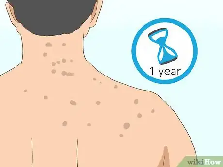 Image titled Get Rid of Back Acne Scars Step 1