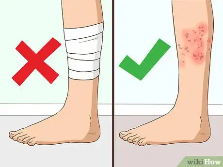 Image titled Use Nystatin Cream Step 10