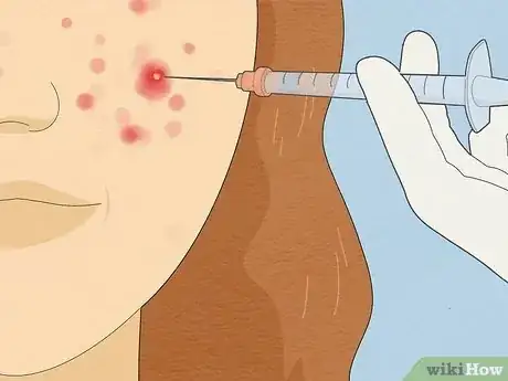 Image titled Tell if Acne Is Hormonal or Bacterial Step 16