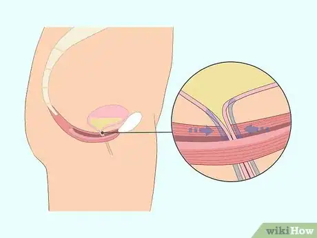 Image titled Do Kegel Exercises Step 1