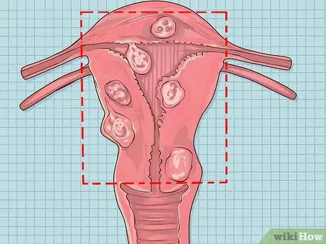 Image titled Decide if You Need a Hysterectomy Step 9