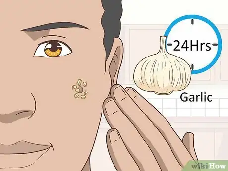 Image titled Remove Facial Warts Step 2