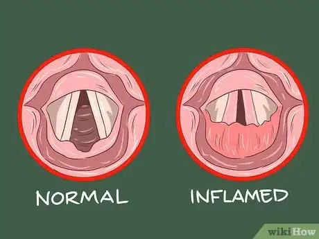 Image titled Know if You Have Laryngitis Step 14