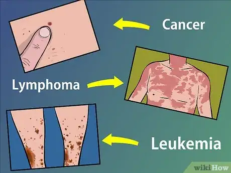 Image titled Treat Shingles (Herpes Zoster) Step 3