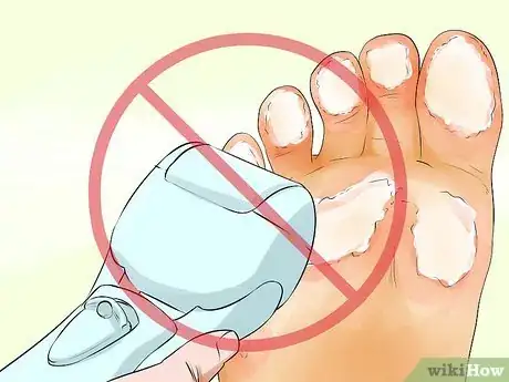 Image titled Prevent Calluses on Hands Step 7