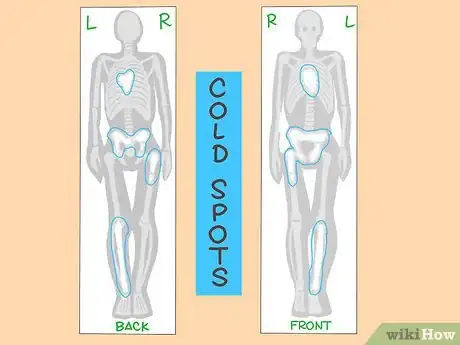 Image titled Understand the Results of a Bone Scan Step 6