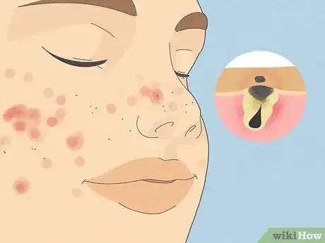 Image titled Tell if Acne Is Hormonal or Bacterial Step 12