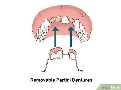 Image titled Buy Dentures Step 5