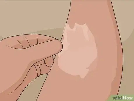 Image titled Remove Scars on Legs Step 17