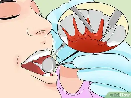 Image titled Clean Your Whole Mouth Step 12