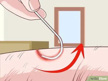 Image titled Remove a Fishhook from Skin Step 15