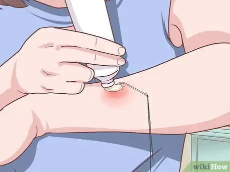 Image titled Remove a Fishhook from Skin Step 12