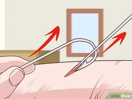 Image titled Remove a Fishhook from Skin Step 13