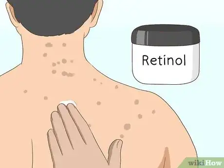 Image titled Get Rid of Back Acne Scars Step 3