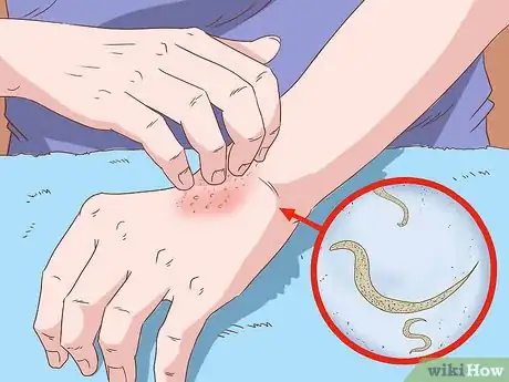 Image titled Recognize and Prevent a Pinworm Infection Step 4