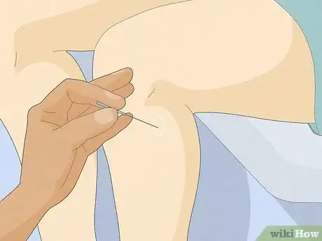 Image titled Ease Constipation with Acupuncture Step 3