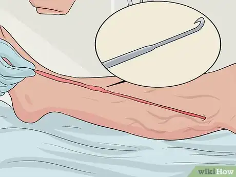 Image titled Get Rid of Varicose Veins Step 15