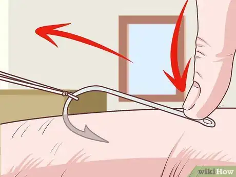 Image titled Remove a Fishhook from Skin Step 11