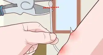 Remove a Fishhook from Skin