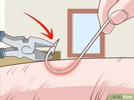 Image titled Remove a Fishhook from Skin Step 14