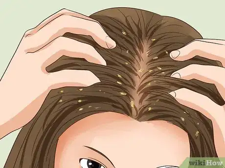 Image titled Diagnose Scalp Psoriasis Step 11