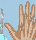 Get Rid of Arthritis Bumps on Fingers