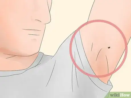 Image titled Identify Tick Bites Step 1