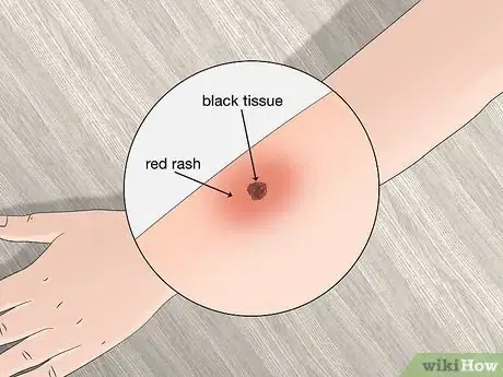 Image titled Identify Tick Bites Step 6