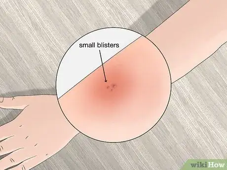 Image titled Identify Tick Bites Step 8