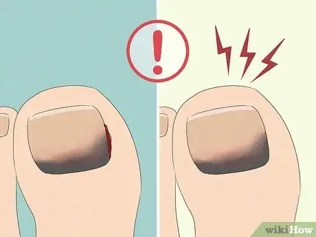 Image titled Treat a Black Toenail Step 1