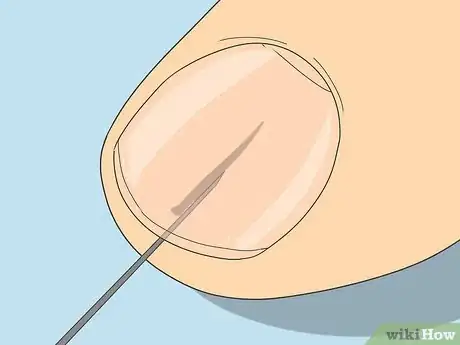 Image titled Remove a Splinter Under Your Fingernail Step 4