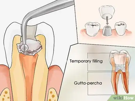 Image titled Treat a Tooth Abscess Step 6