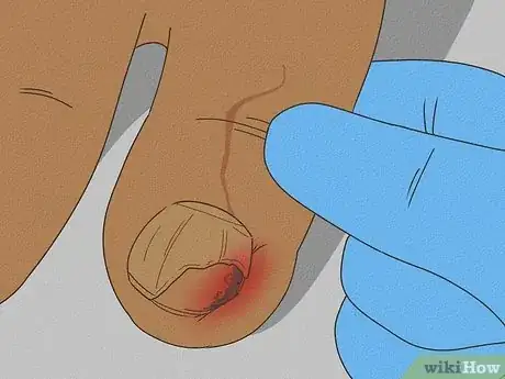 Image titled Treat a Torn Toenail Step 10