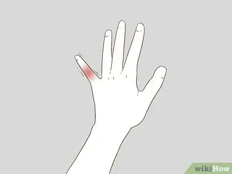 Image titled Determine if a Finger Is Broken Step 3