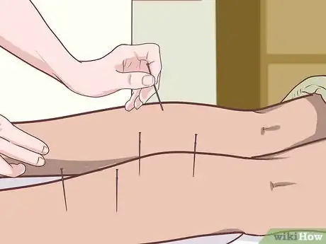 Image titled Treat Fibromyalgia with Acupuncture Step 1