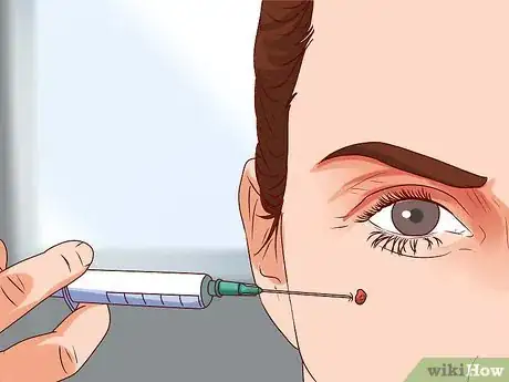 Image titled Get a Skin Tag Removed by a Doctor Step 3