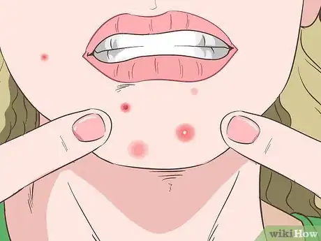 Image titled Recognize Staph Infection Symptoms Step 1