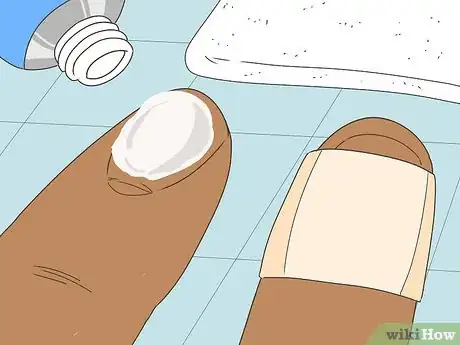 Image titled Remove a Splinter Under Your Fingernail Step 5