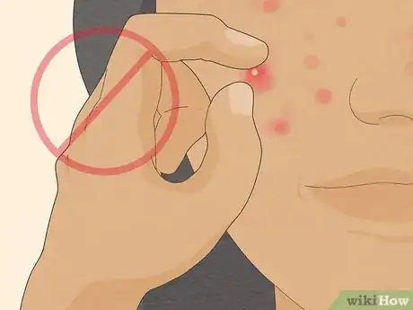 Image titled Get Rid of Cystic Acne Scars Step 21