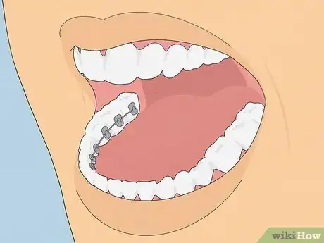 Image titled Straighten Your Teeth Without Braces Step 12